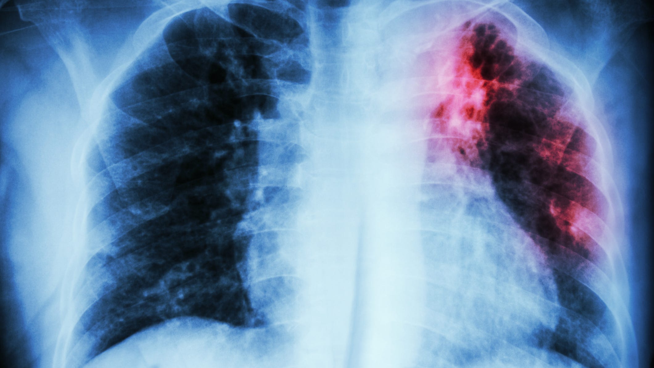 Global TB deaths are higher than they have been in a decade