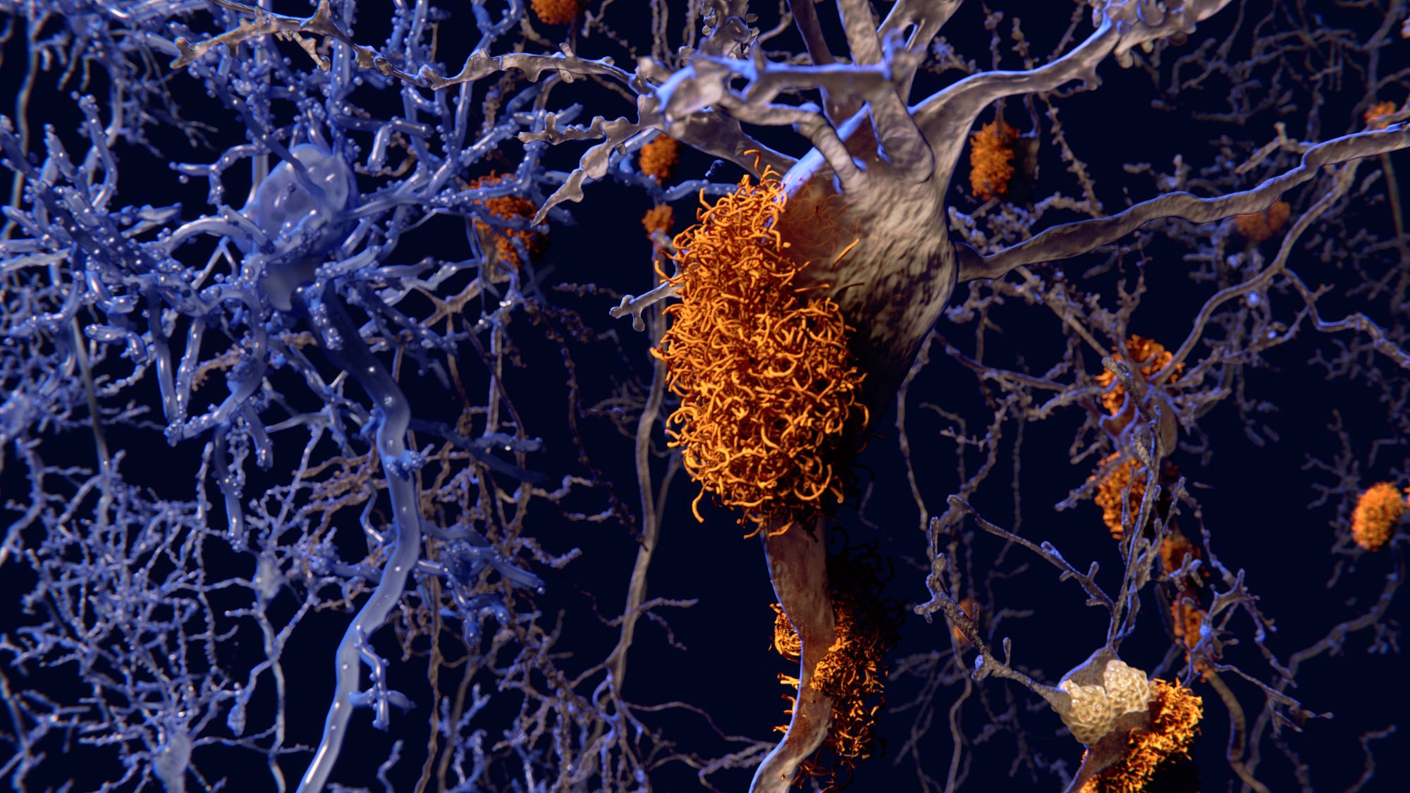 42 new genes discovered as linked to Alzheimer’s disease