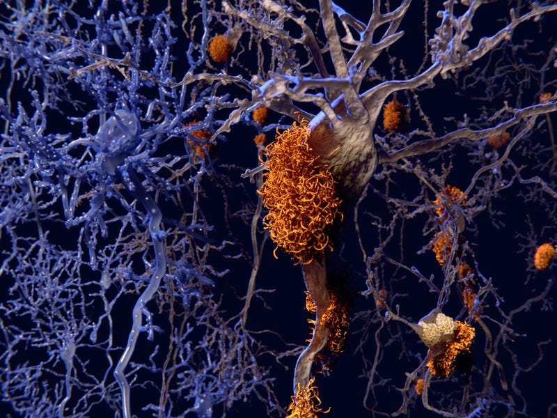 Neurons with amyloid plaques (right side) compared to healthy neurons (left). Amyloid plaques accumulate outside neurons. Amyloid plaques are characteristic features of Alzheimer's disease. They lead to a degeneration of the affected neurons, that are destroyed through the activity of microglia cells.