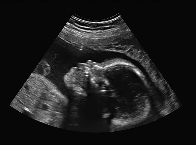 ultrasound showing a baby