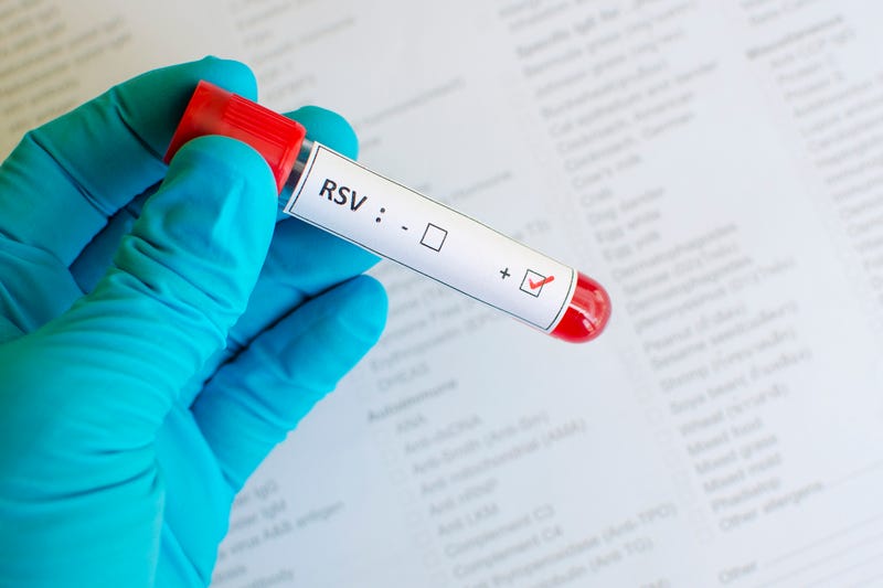 Blood sample with respiratory syncytial virus (RSV) positive