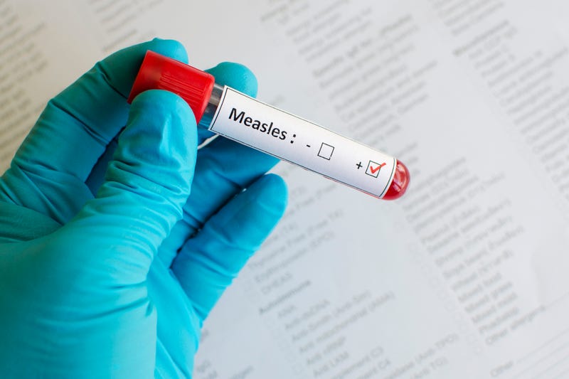 More measles cases confirmed in southwest Kansas