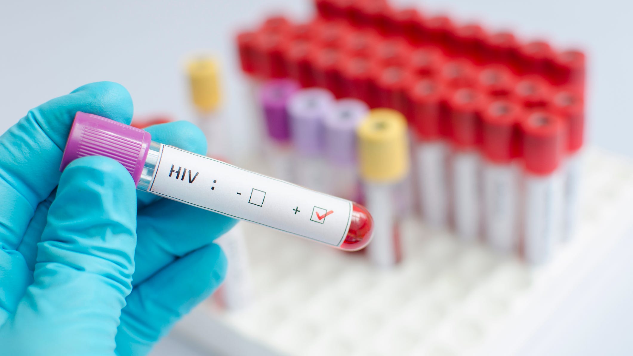 New HIV infections, especially among young gay men, have fallen in recent years