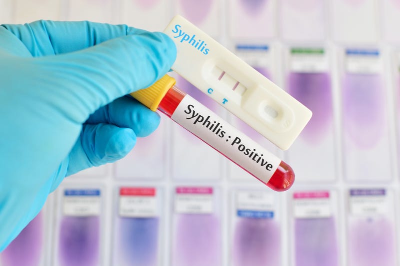 Positive syphilis test