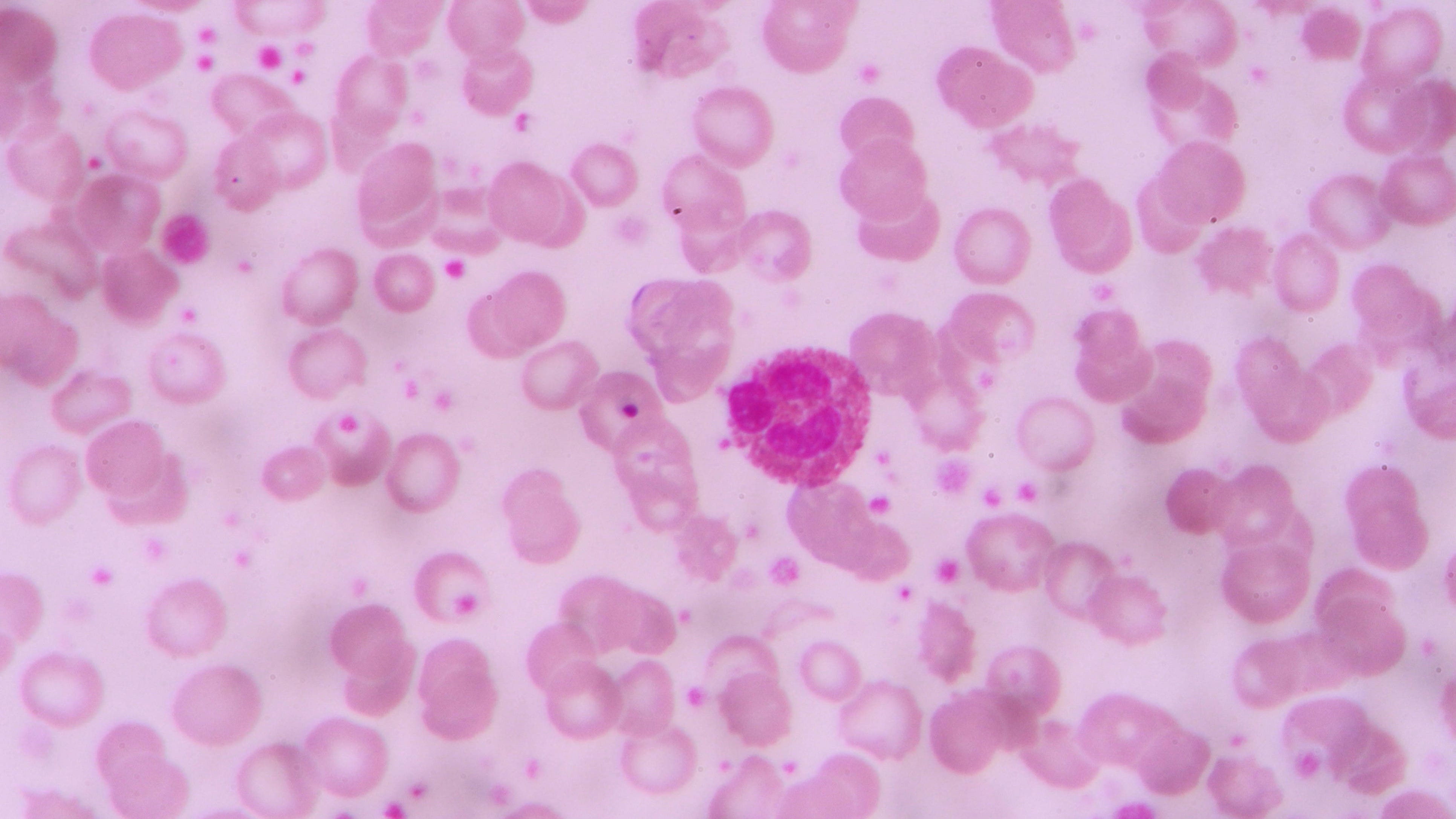 Gene-editing technology could be key to curing debilitating disease