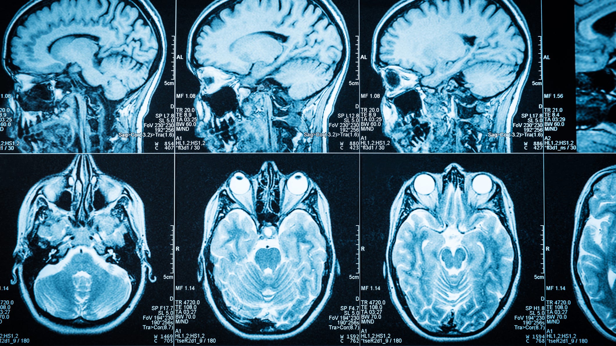 How Bay Area doctors rewired a woman's brain to fix her severe depression