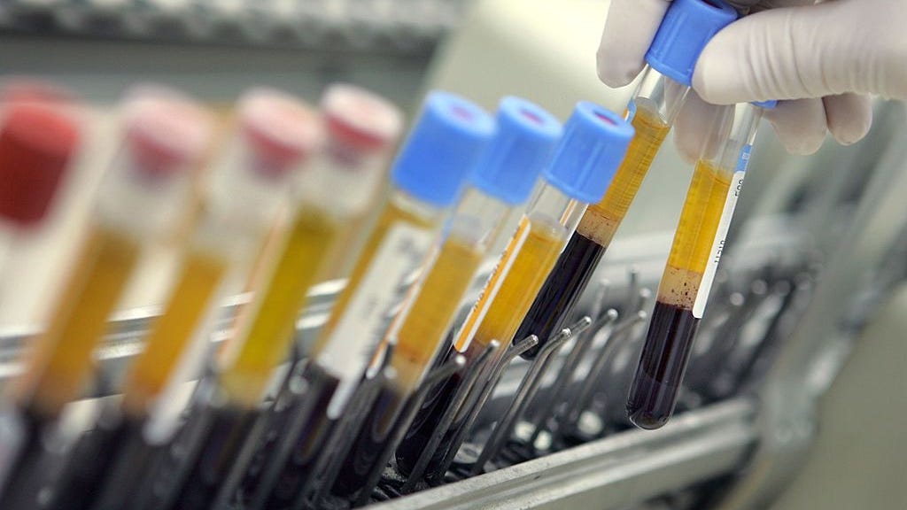 Blood test provides vital answers for patients with traumatic brain injuries