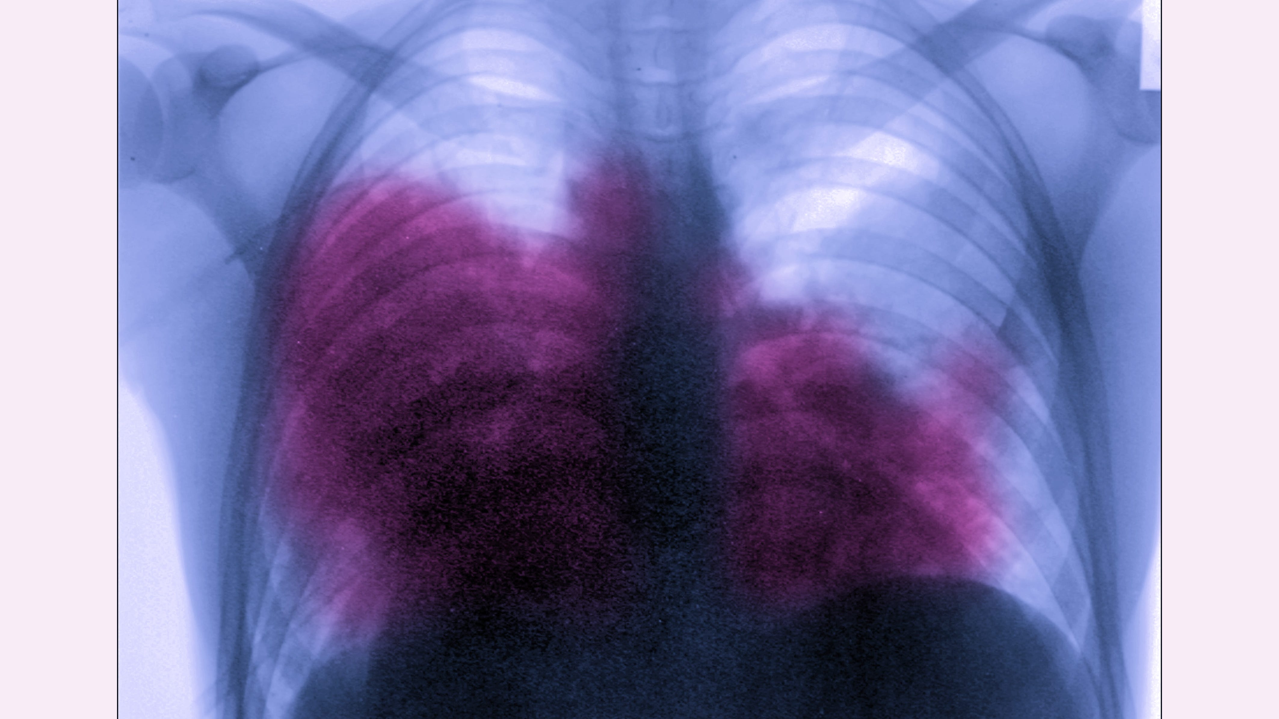 9 hospitalized in cluster of Legionnaires’ disease being investigated by Health Dept.