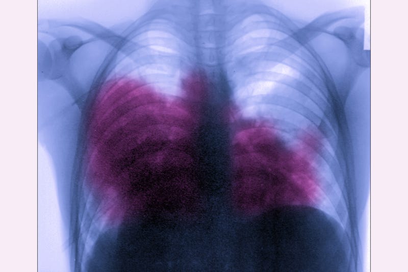 Acute bilateral pneumonia (legionnaires disease caused by Legionella pneumophila), seen on a frontal chest x-ray.