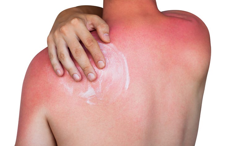 Sunburn