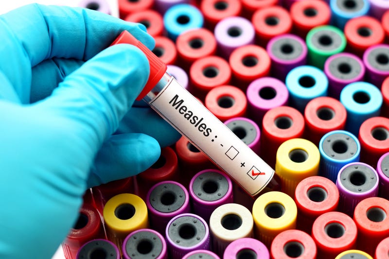 measles