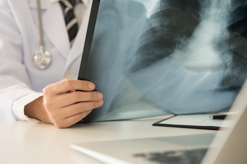 Doctor examining lung x-rays