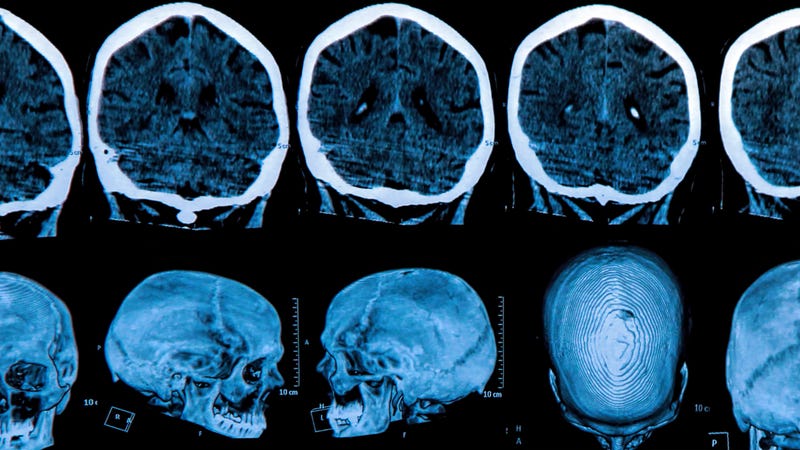 MRI scans of the human brain