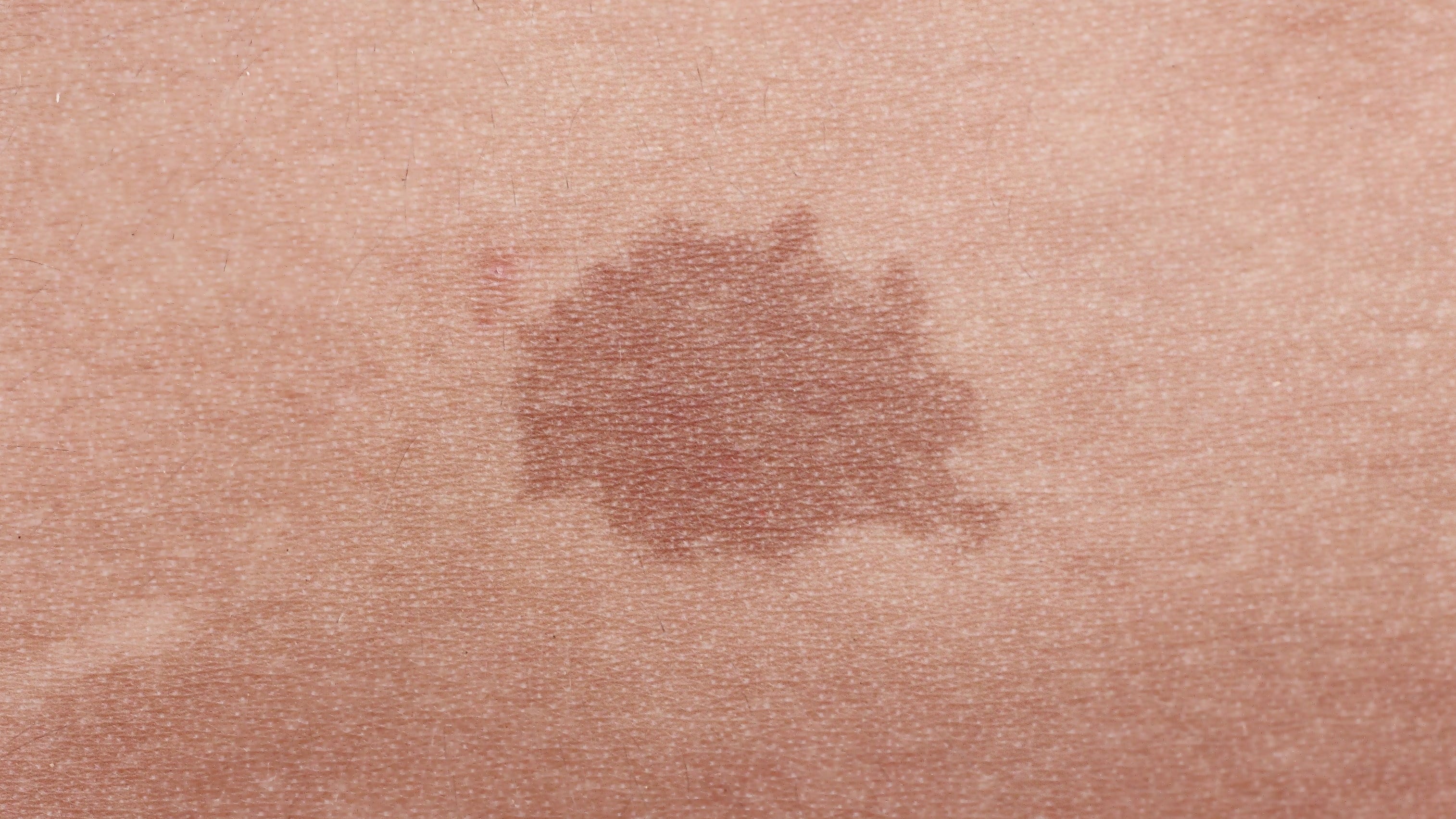 Birthmark could be sign of rare condition in kids