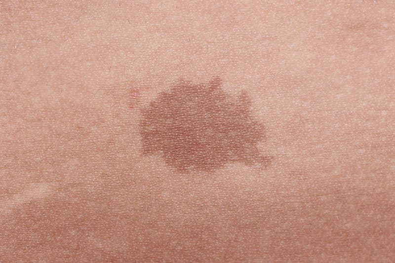 Flat, light brown birthmark.