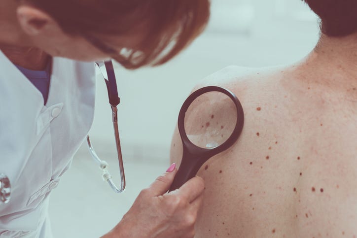 Doctor examining a patients skin for melanoma.
