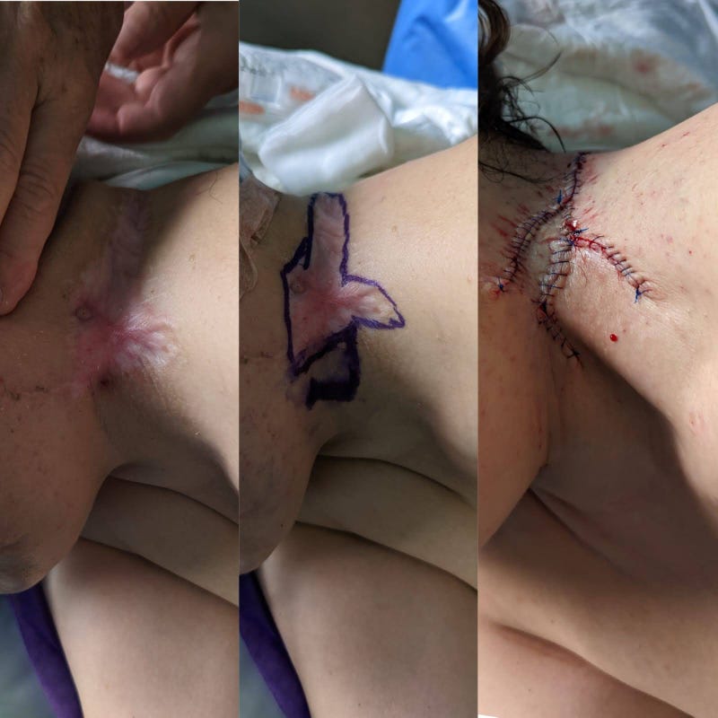 Wound repair progression