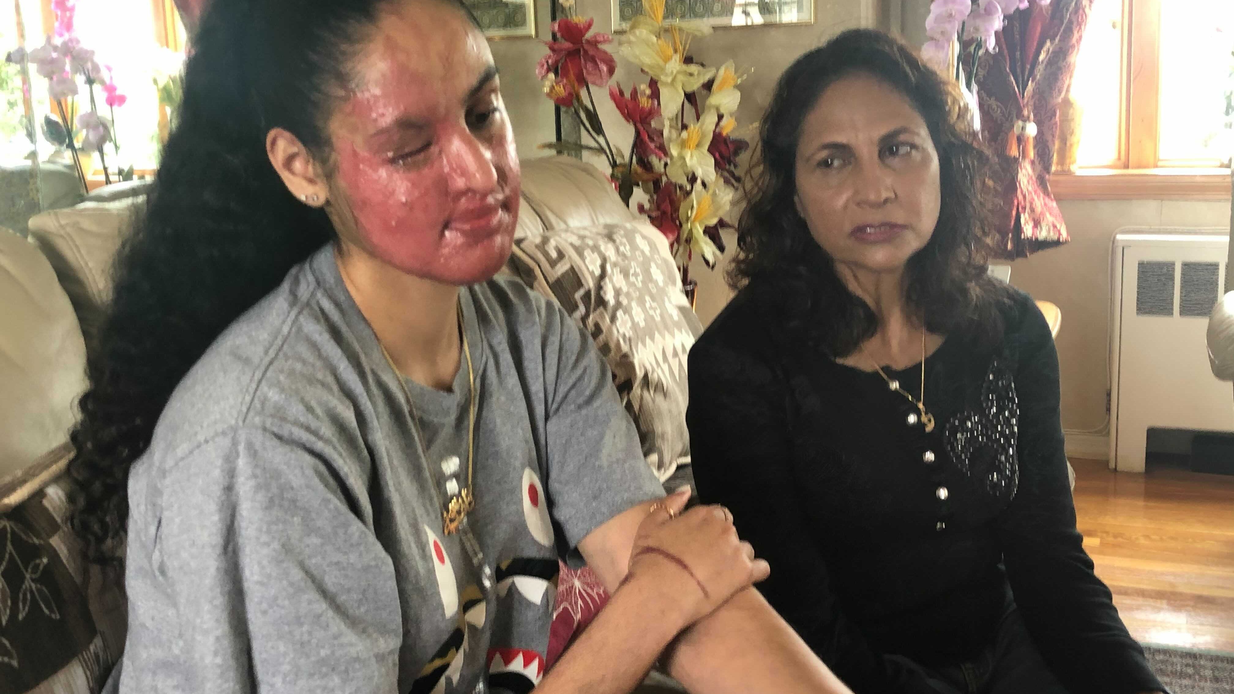Acid attack victim not giving up hope that assailant will be caught