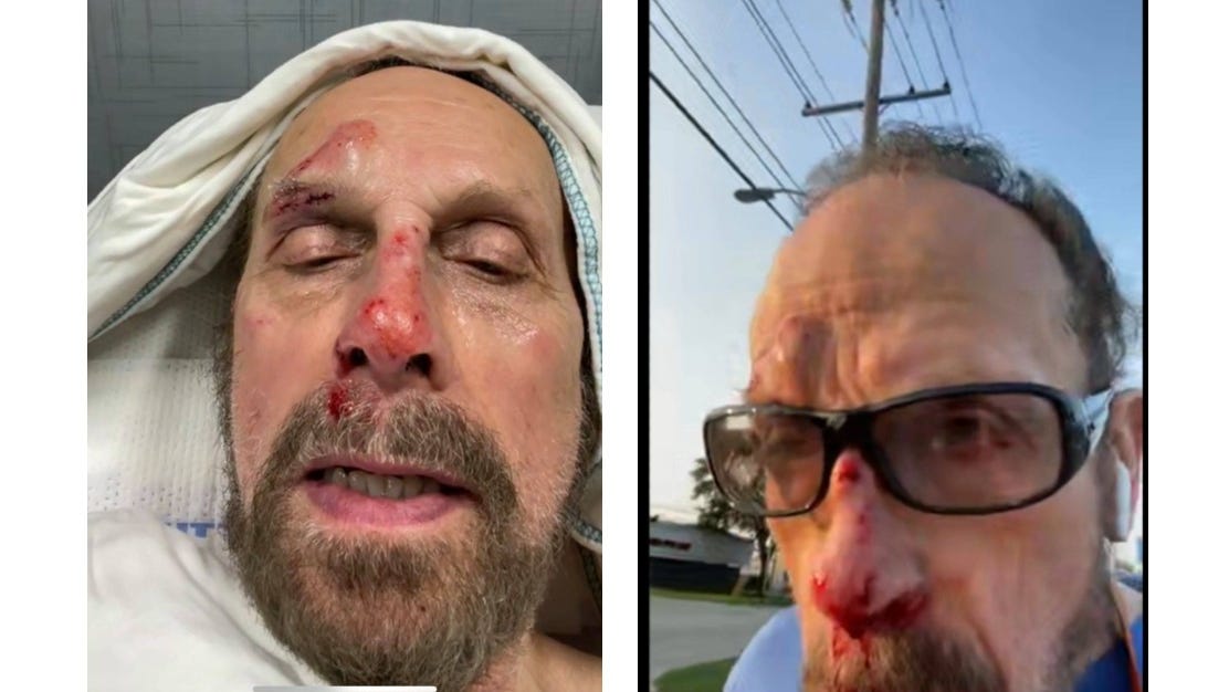 Warren Mayor Jim Fouts recovering after falling on city sidewalk during run