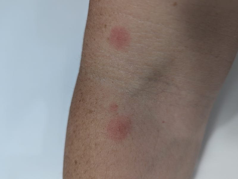 Mite bites