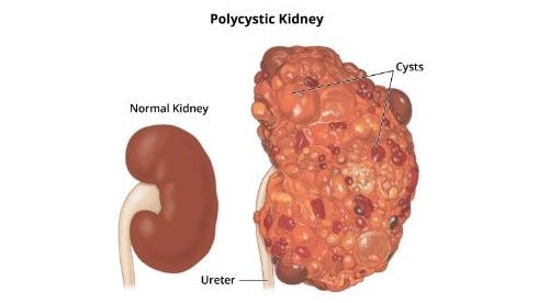 Polycystic kidneys grow numerous cysts and can weigh as much as twenty-five pounds.