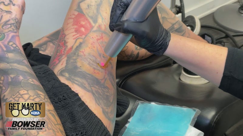 "Zombie Elvis" gets zapped with a tattoo removal laser
