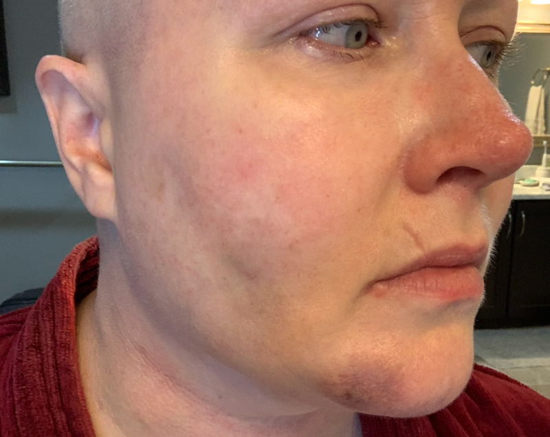 Lymphoma, swollen and bruised nodes