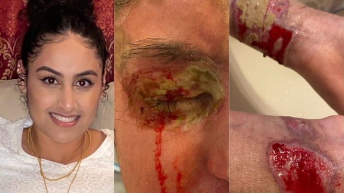 A photo showing 21-year-old Nafiah Fatima before and after the assault on March 17, 2021