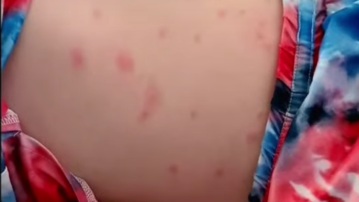 At least 12 kids develop rash after swimming in lake at Phil’s Beach; Wauconda residents want answers