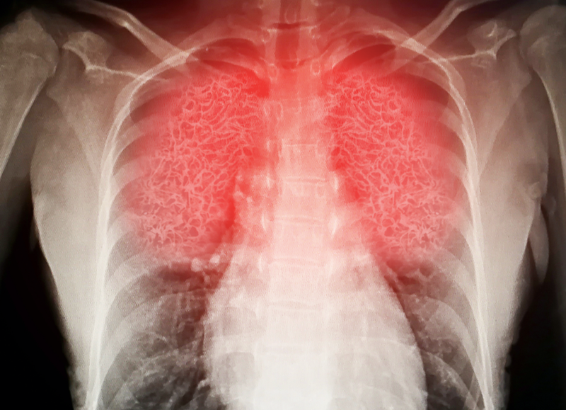 lungs x-ray image