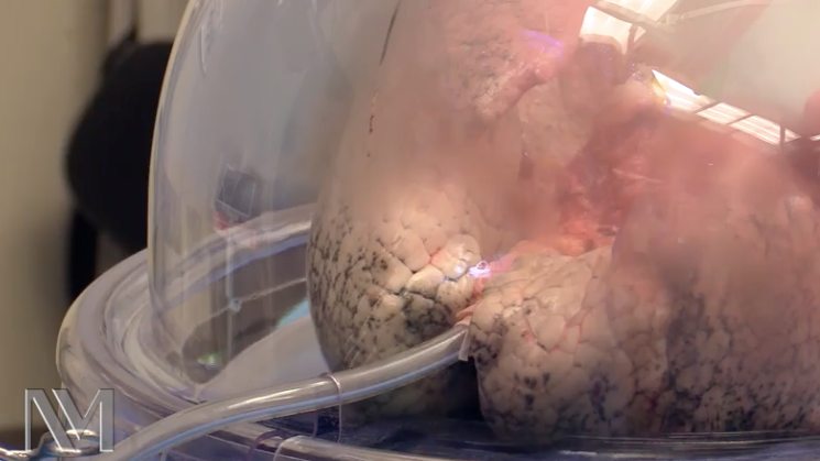 Northwestern surgeons use 'lungs in a box' technology to evaluate, repair donor organs