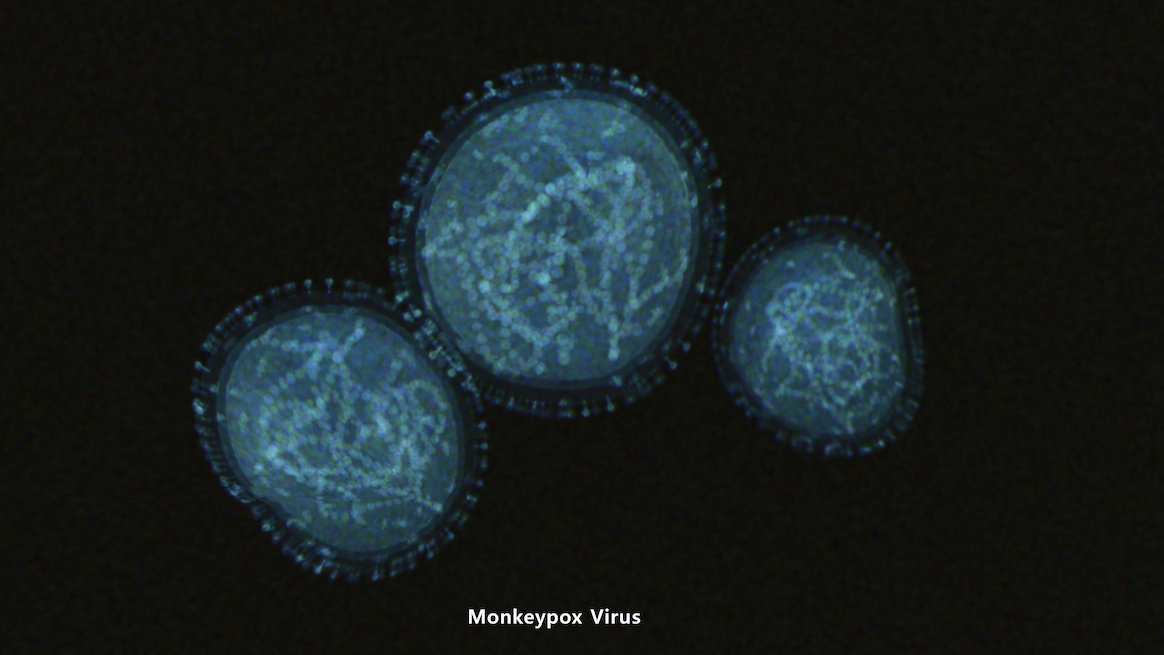 Evanston reports suspected case of monkeypox