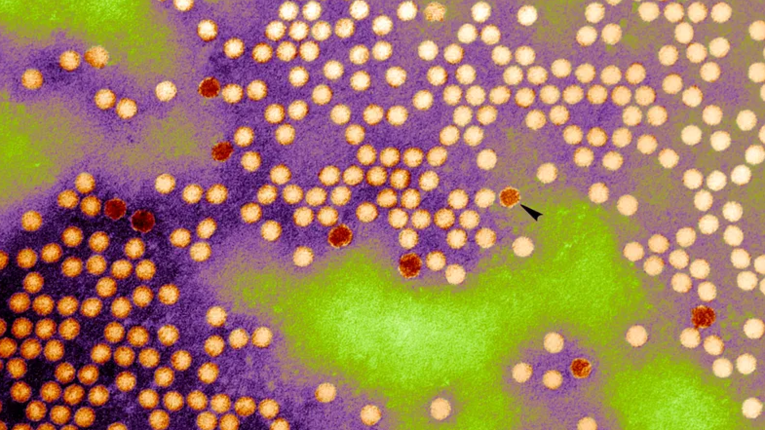 Polio found in Rockland wastewater, NY Health Dept. says vaccination 'critical'