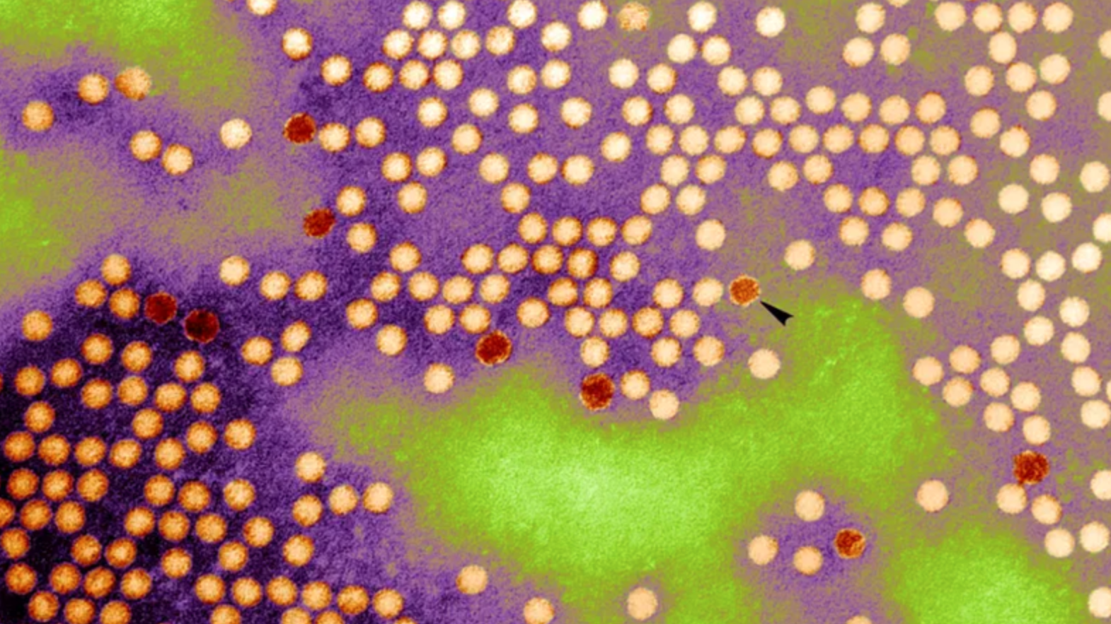 POLIO IN 2 NY COUNTIES: Indicates 'potential community spread,' says Health Dept.