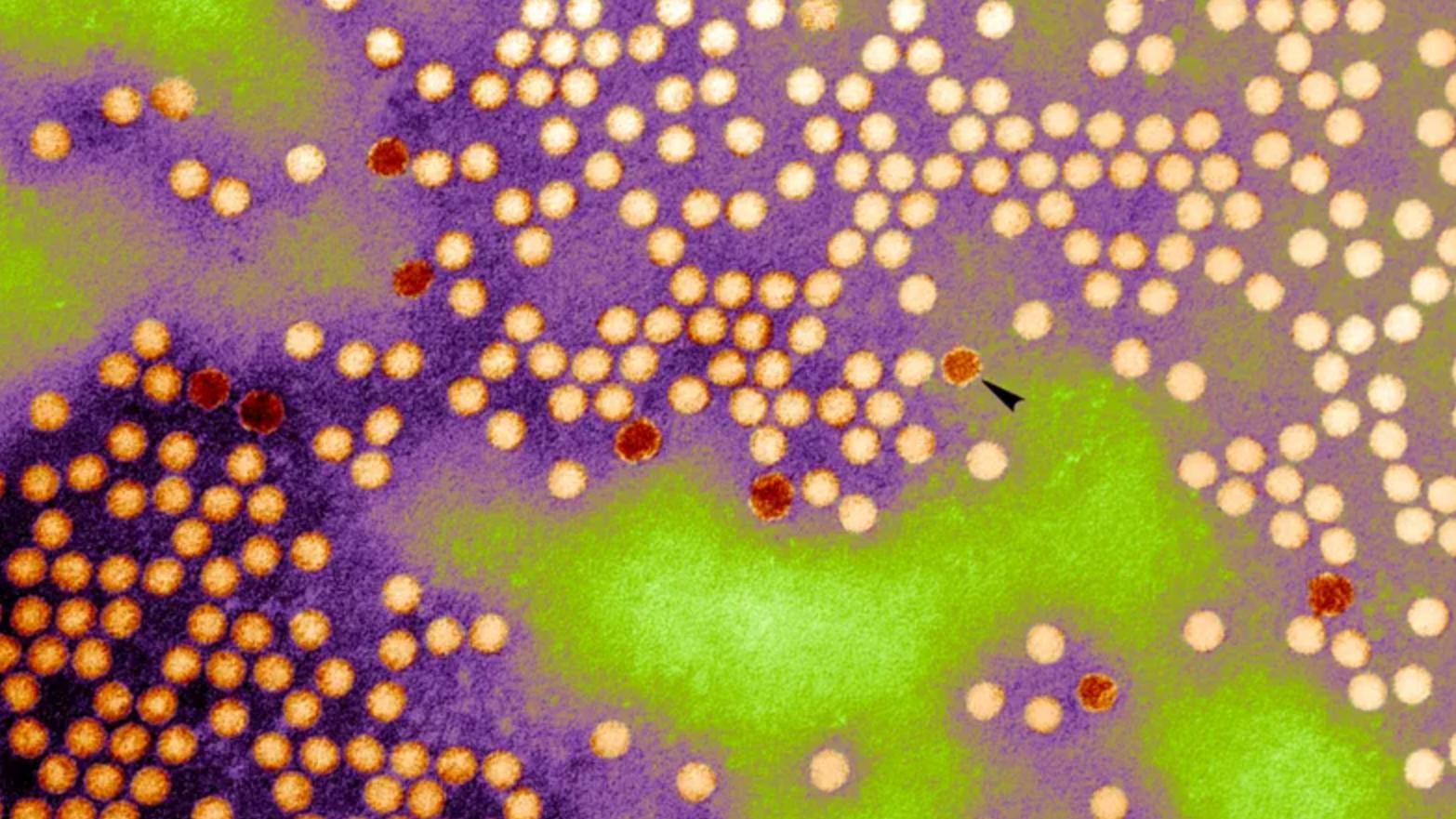 State of emergency declared after polio found in Nassau County wastewater