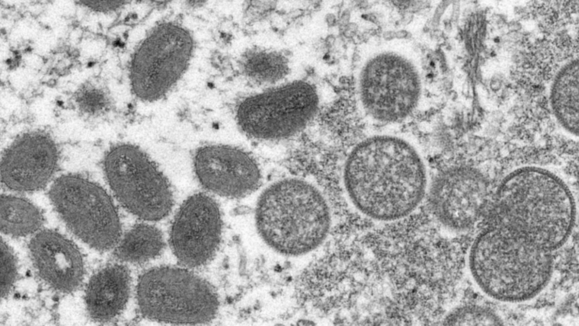 1st monkeypox case found in Nassau county as vaccine rollout begins