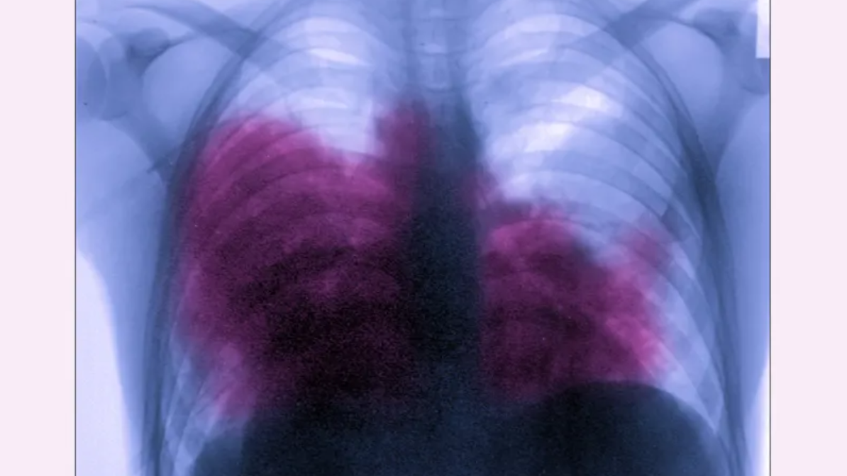 Bronx Legionnaires' outbreak victims sue building owner for contaminated water