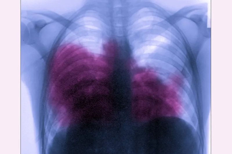 Acute bilateral pneumonia (legionnaires disease caused by Legionella pneumophila), seen on a frontal chest x-ray.