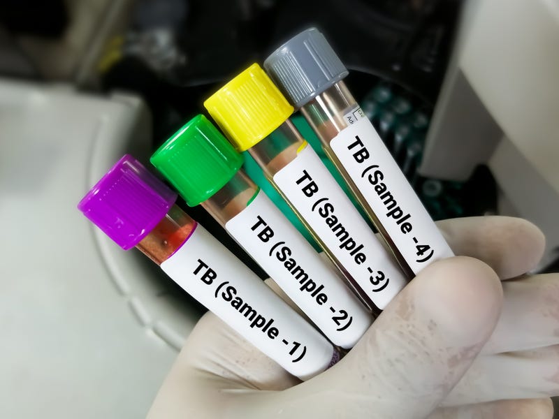 Close view of scientist hand hold blood samples for TB Gold or Quantiferon test. 