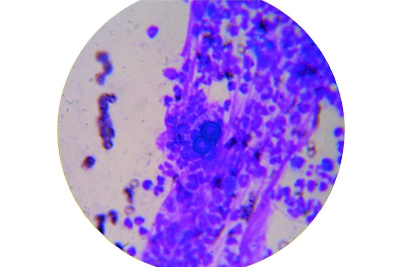 Blastomycosis is a fungal infection that often has flu-like symptoms.