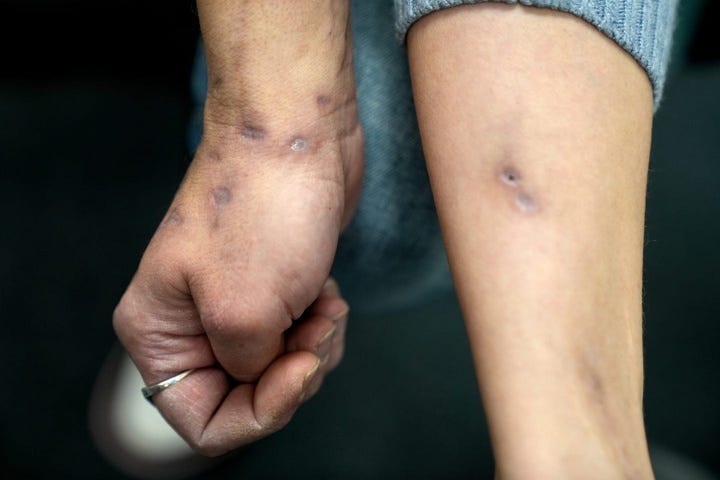 Xylazine-induced lesions cover a woman's arms and other parts of her body.