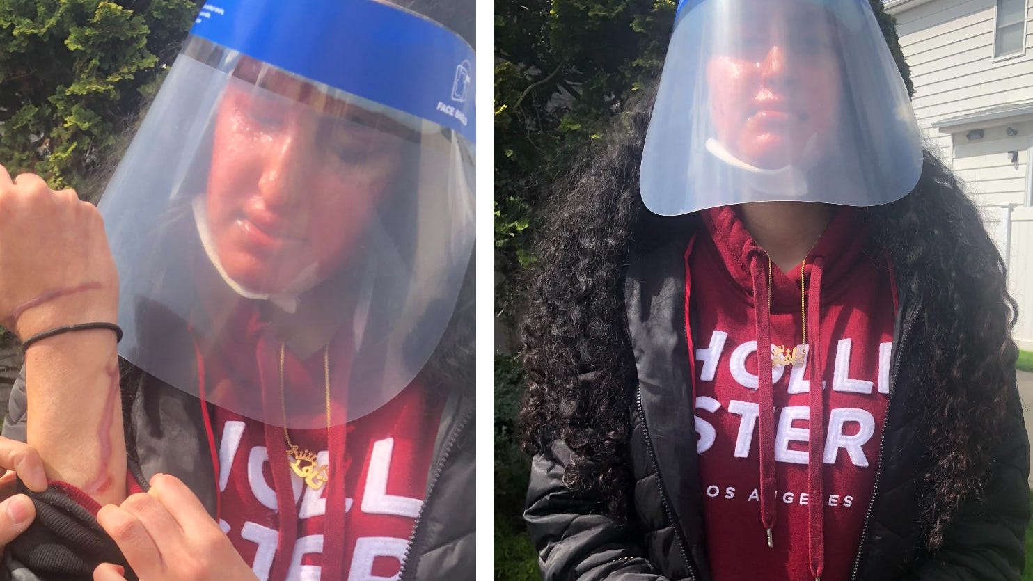 ‘This is just inhumane’: 21-year-old Hofstra student speaks out after brutal acid attack
