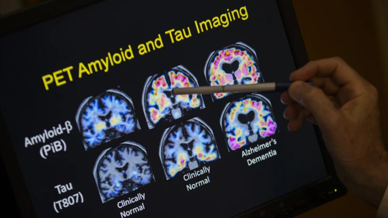 A doctor points to PET scan results that are part of a study on Alzheimer’s disease at Georgetown University Hospital, on Tuesday, May 19, 2015, in Washington