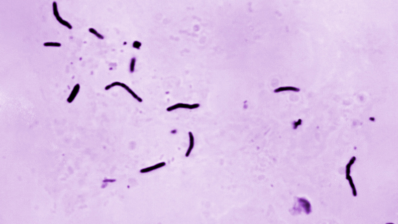 Tuberculosis