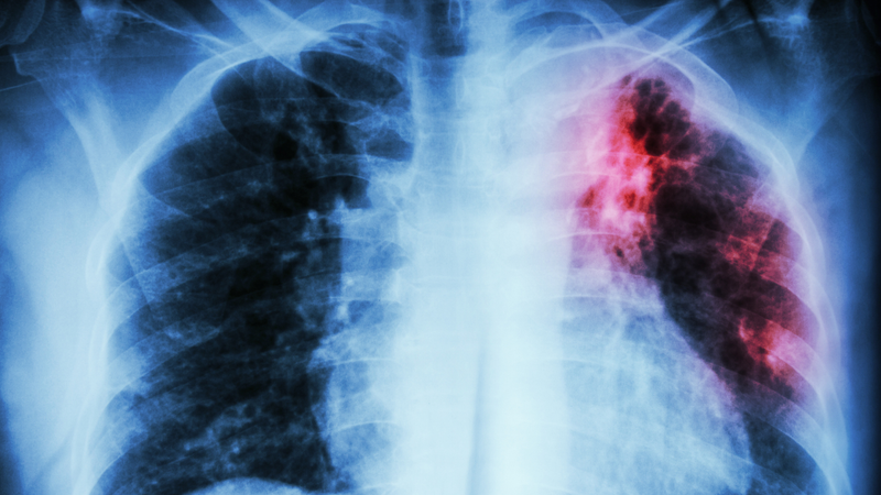 Tuberculosis Outbreak