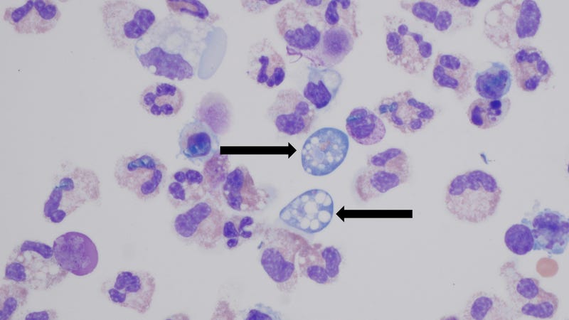 CDC Naegleria fowleri