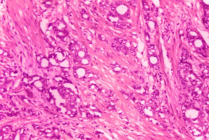 Prostate Cancer Treatment
