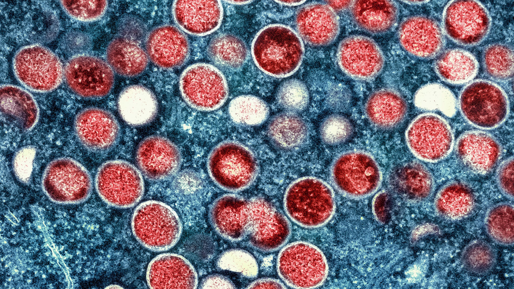 WHO renames monkeypox as mpox, citing racism concerns