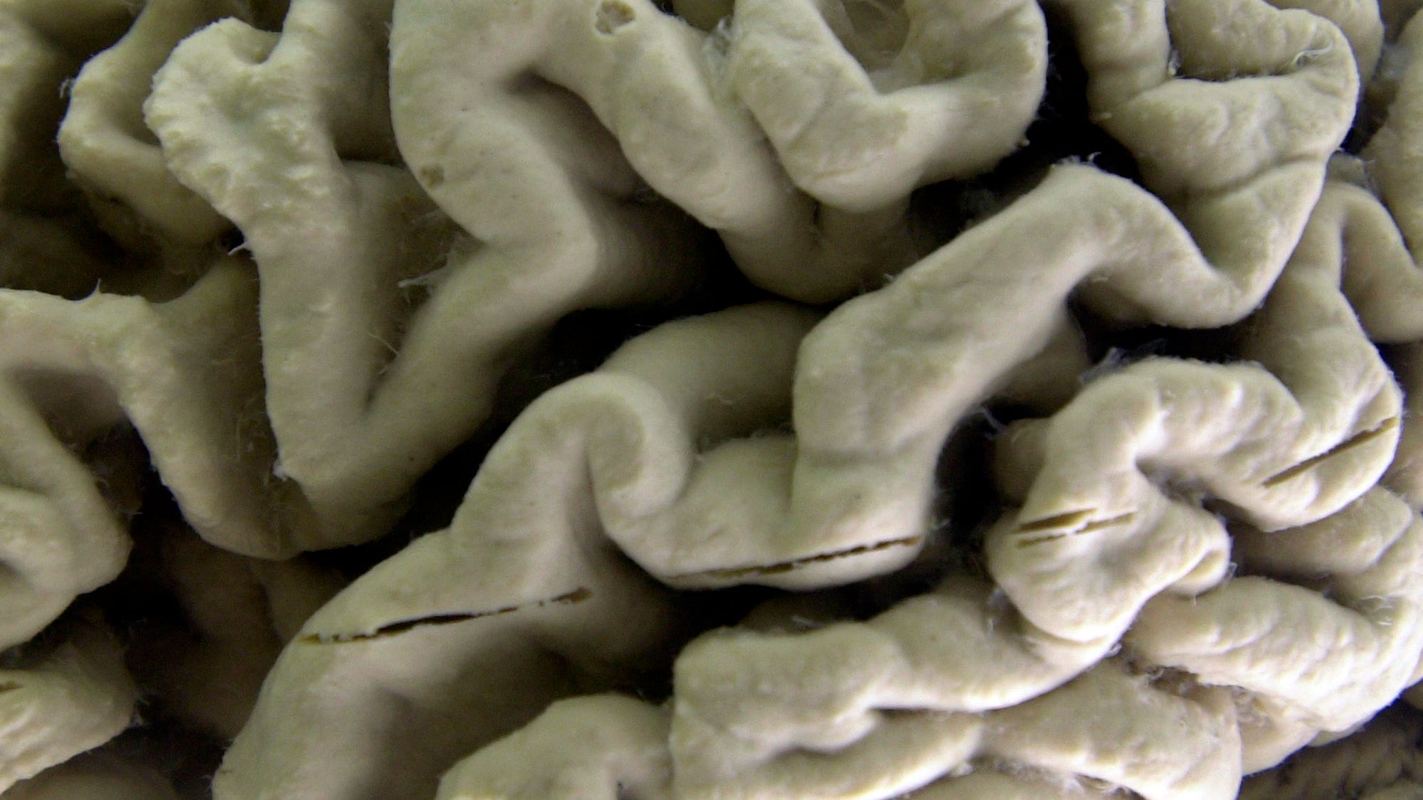 Drug slows Alzheimer's but can it make a real difference?