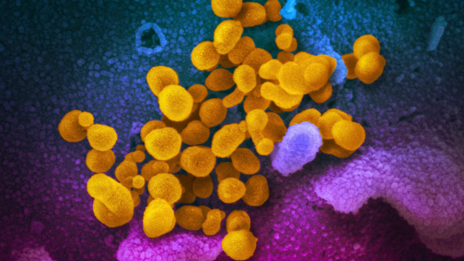 Most kids with serious inflammatory illness had mild COVID 